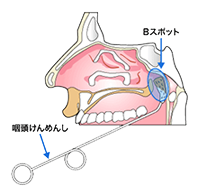 のどの病気イラスト